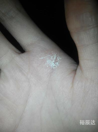 手指虎口处长硬疙瘩手指虎