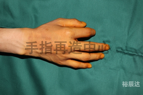 手指虎口疼是怎么回事手指虎-第2张图片