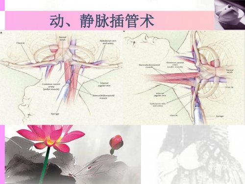 插管第2460期动态图插管第2460期动态图，插管技术的最新进展与临床应用-第2张图片