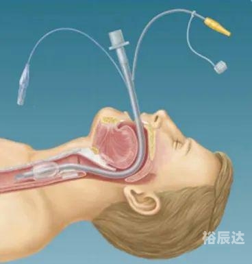 插管图2460期软件插管第2460期动态图，插管技术的最新进展与临床应用-第3张图片