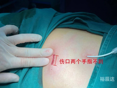 插管第2460期动态图，插管技术的新里程碑-第2张图片